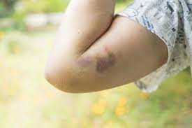 What is a contusion (bruise)? Bones, muscles, and more