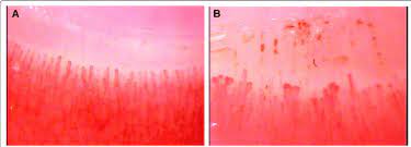 nailfold capillaroscopy showing a