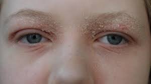 eyelid dermais treatments symptoms