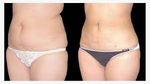liposuction scars how to treat and