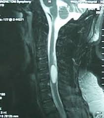 spinal cord tumors lillian s wells