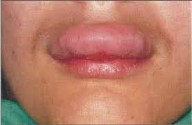 angioedema of the upper lip 33