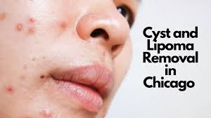 cysts lipoma removal in chicago il