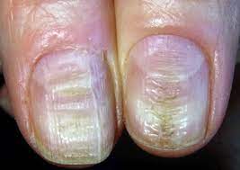 nail dystrophy definition causes