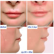 lip lift harley clinic