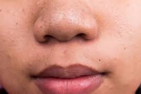 blackheads on nose causes prevention