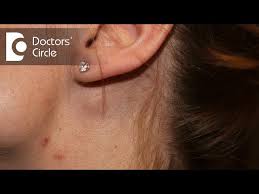 what causes swelling of lymph node near