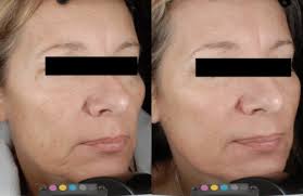 tetra co2 cooll laser treatment in