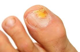 ankle doctor for toenail fungus