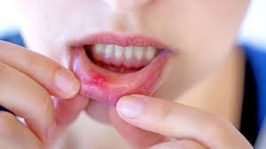 canker sores and cold sores