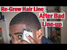 how to regrow your hairline naturally