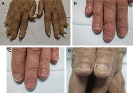 nail psoriasis in older s