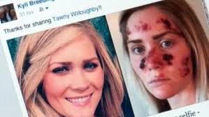 tanning bed horror story as images go viral