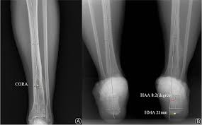 distal tibial fracture