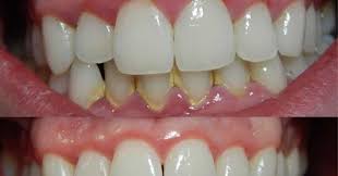 Temukan berbagai klinik gigi terbaik hanya di hdmall. Harga Cuci Gigi Klinik Kerajaan