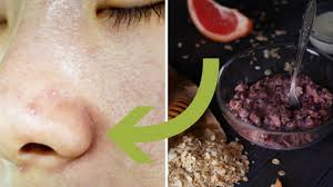 However, whiteheads on the nose keep coming back; 5 Whiteheads On Nose Removal Home Remedies Whiteheads Removal Hack Nose Youtube