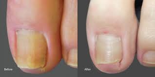 toenail laser before after photos