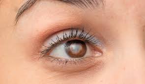 cataracts causes symptoms and
