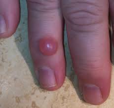 fingertip ganglion cysts mucous cysts