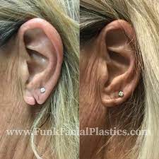 earlobe repair houston split torn