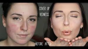 make up tutorial for rosacea party