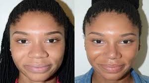 wide nose rhinoplasty a surgery to