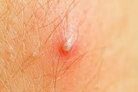 home remes for ingrown hair cyst