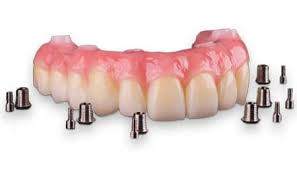 all on 6 dental implants cost mexico