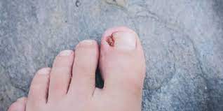 dealing with an infected ingrown toenail