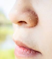 dry skin around the nose