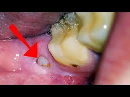 wisdom tooth pain what you need to