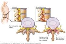 Image result for 6 levels of stenosis of the spine on medicare what choices do i have