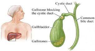 signs you re having gallbladder