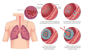 Tuberculosis generally affects the lungs, but can also affect other parts of the body. Tuberculosis Doctors Australia