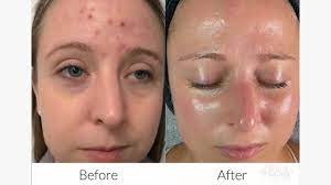 microneedling under the eyes procedure