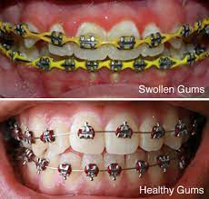 swollen gums and braces are they
