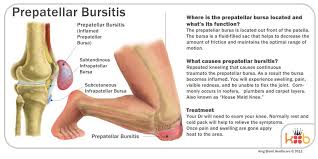 Carpet layers/roofers because of the continuous pressure going through the prepatellar bursa. Sports Injury Clinic On Twitter Know About Prepatellar Bursitis Bursitis Kneepains Kneeling Kneeswelling Sports Sportsinjury Http T Co Bhdwd7mv1q