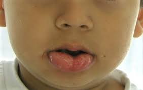 faq bitten lip discovery pediatric