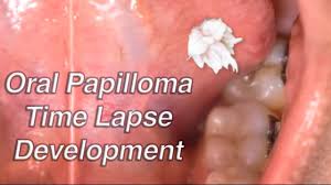 papilloma development time lapse