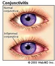 Here are the ways that tell you how to cure the flu naturally. Pink Eye Conjunctivitis Symptoms Causes Treatment Prevention