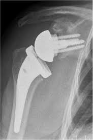 orthopedic shoulder elbow surgeon