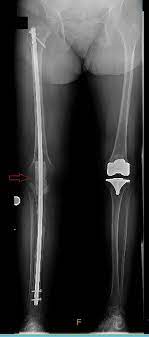 infected total knee arthroplasty