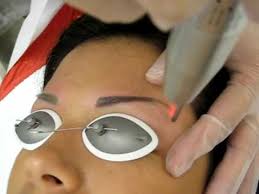 laser tattoo removal permanent makeup