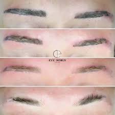 cosmetic tattoo laser removal eyebrow