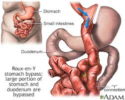 gastric byp surgery information