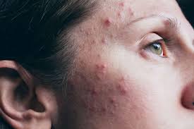 acne vulgaris types symptoms causes