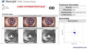 Lasik Hyperopia Eye Tracker Laser Ex500 Dr Damien Ganeshan