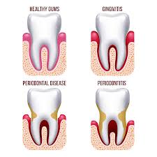 periodontal disease causes treatment