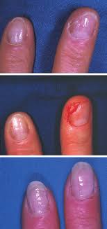 partial fingernail defect after trauma