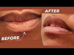 dry chapped ling lips remedy in